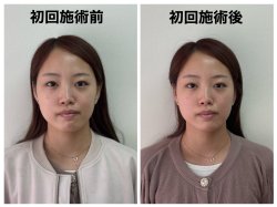 施術後に気をつけること